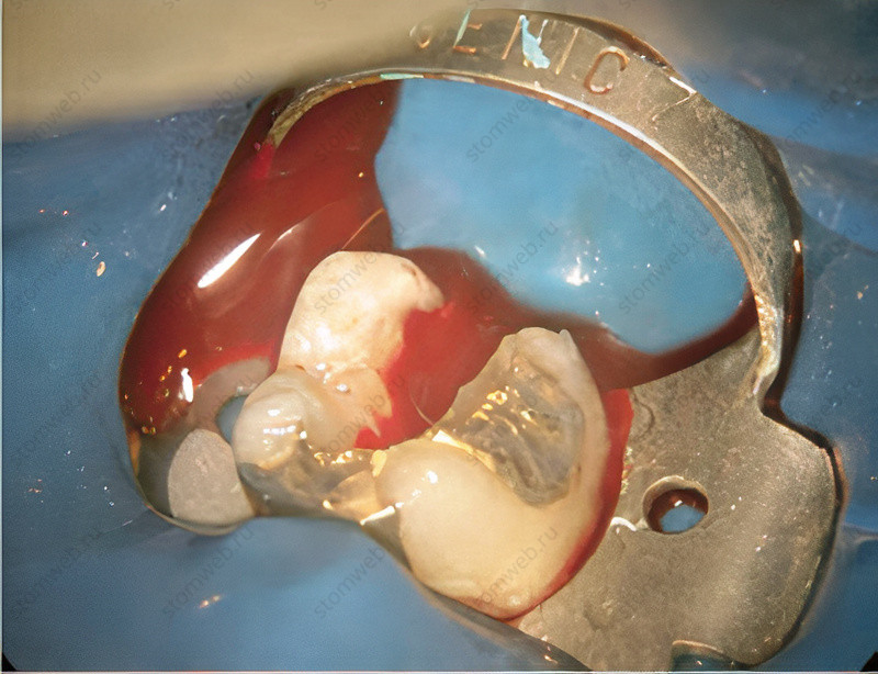 Рисунок 7.7 (а) и (b) Дренирование гноя и крови через полость доступа в моляре нижней челюсти при остром альвеолярном абсцессе.
