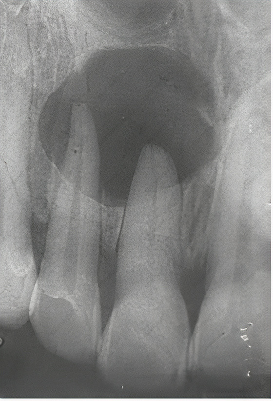 Рисунок 7.9 (а) Рентгенографический вид, (b) клинический вид и (c) аспирация серозного экссудата при экстрарадикулярной инфекции.