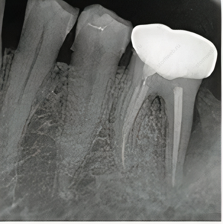 Рисунок 7.6 J-образный участок рентгенпрозрачности, указывающий на вертикальный перелом дистального корня моляра нижней челюсти.