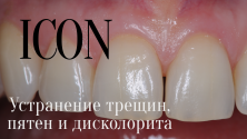 lection